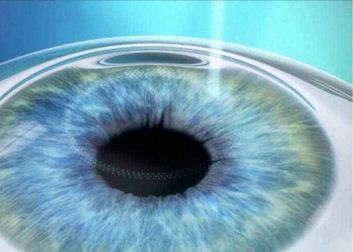 94 Phau thuat Relex Smile